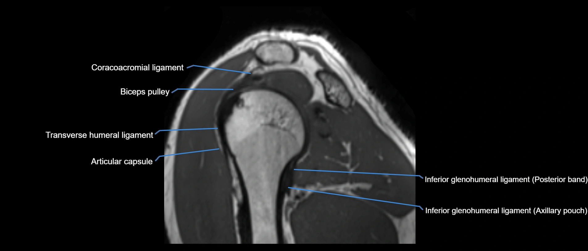 shoulder ligaments sagittal  cross sectional anatomy 3T MRI AI enhanced radiology image -img-00001-00037.webp